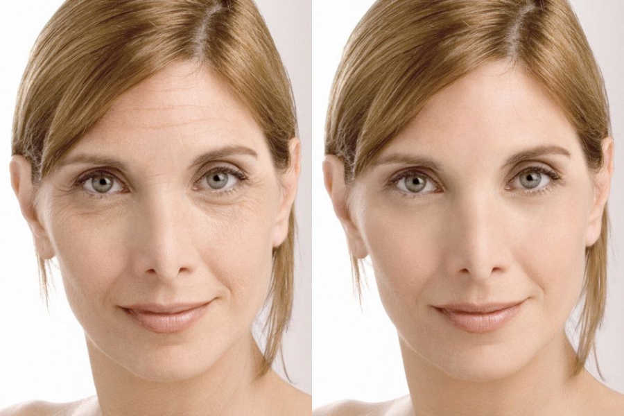 Уколы от морщин на лице фото до и после
